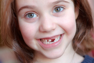 The adorable girl smiles with the fall of the first baby teeth.