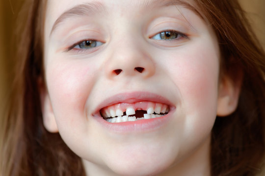 The adorable girl smiles with the fall of the first baby teeth.