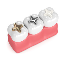 3d render of teeth with different types of dental filling