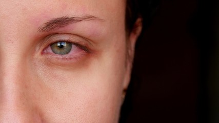 Sick red human eye of a young woman. A girl takes off her glasses, showing a red eye. Tired eyes...