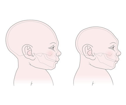Comparative anatomical image of the head and skull of a newborn child with a normal cranium and with microcephaly. The virus of Zika. Vector. Isolated on white background