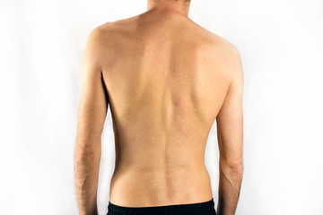 scoliosis of the back of a man selective focus, white background - obrazy, fototapety, plakaty