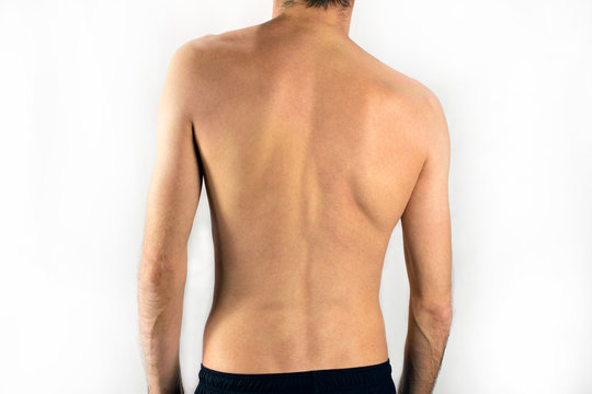 scoliosis of the back of a man selective focus, white background