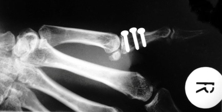 Handknochen