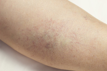 Naklejka premium Varicose veins on the leg