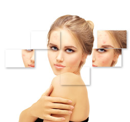 Post-Acne Marks /Treating Acne Scars