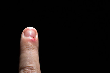 Right bruised finger on a black background