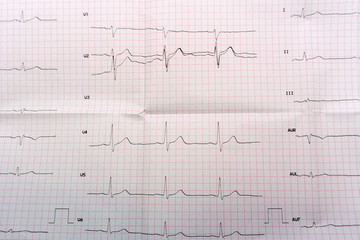 Emergency cardiology and intensive care. ECG with acute period of large-focal widespread anterior myocardial infarction .