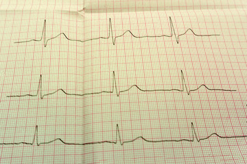 Extrasystole On 12 Lead Electrocardiogram Record Paper .