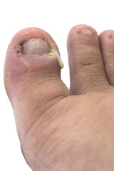 Close up figure out the nail, Accident nail trauma, abscess bleeding toe nails.