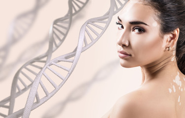 Young sensual woman with vitiligo in DNA chains.