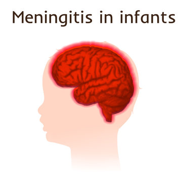 Meningitis in infants. Vector medical illustration. Kid, baby, childhood. White background, silhouette of child head, anatomy image of brain.
