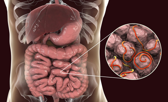 Helminths nematodes Enterobius in the gut. Threadworm which causes enterobiasis, 3D illustration showing close-up view of threadworms located in large intestine