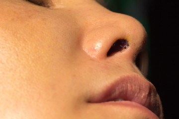 Close up woman nose with scar from plastic surgery.
