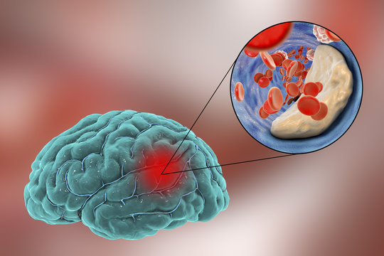 Ischemic brain stroke concept, 3D illustration showing human brain and close-up view of blood vessel obturated with cholesterol plaque