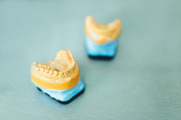 Dental gypsum model of the teeth in the cliinic