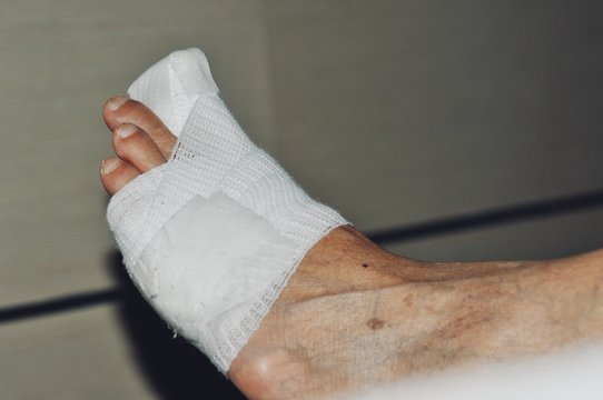 Close-up Of A Orthopedist Fixing Plaster On Injured woman’s Foot in hospital, Splint for treating foot injuries. Health care and medical treatment concept