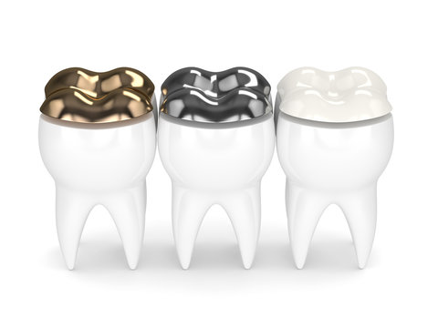 3d render of teeth with gold, amalgam and composite onlay dental filling over white background