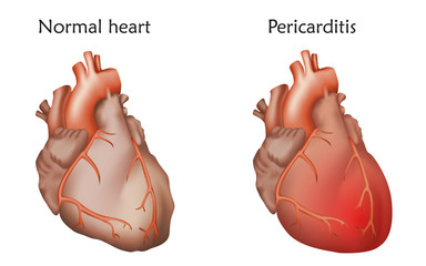 Pericarditis. Inflammation of the pericardium. Damaged and normal heart muscles. Anatomy illustration. Colorful image, white background.