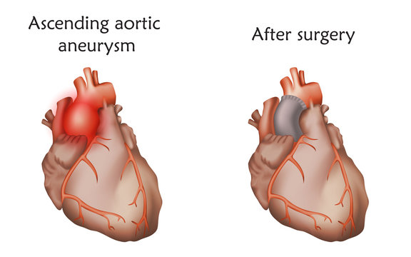 Ascending aortic aneurysm before and after repair. Tube graft and damaged heart muscle. Anatomy illustration. Colorful image, white background.