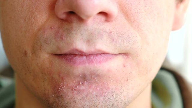 Skin irritation after shaving. Man scratching with his arm pimples on the chin. Closeup of nose, lips and chin