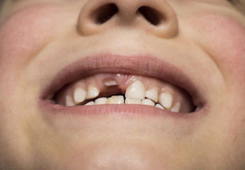 child laughs opening his mouth. Curves molars. child shows the growth of the root tooth