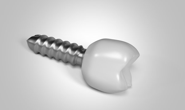 Dente e impianto dentale