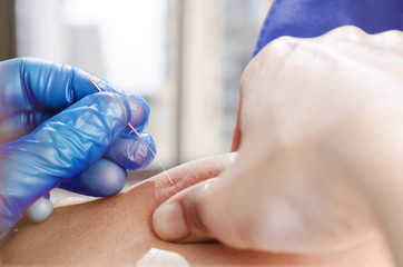 Needle and hands of physiotherapist doing a dry needling