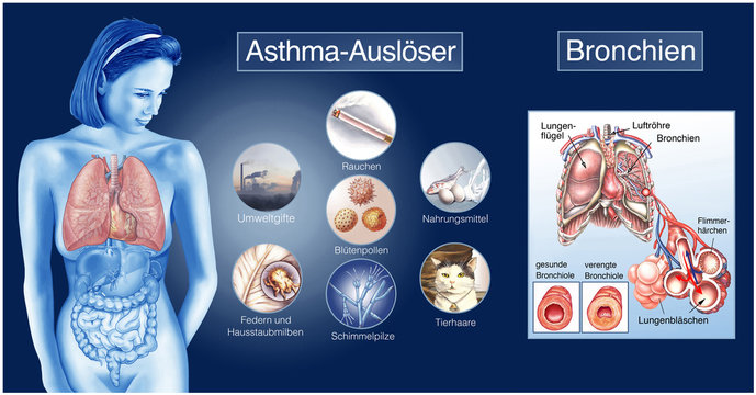 Asthma-Ausl&ouml;ser.Allergien.Verengte Bronchien