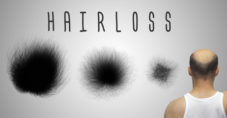 Alopecia concept. Set showing the hairloss progress.