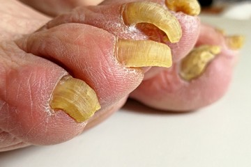 Fungus infection on nails of man's foot