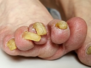 Fungus infection on nails of man's foot