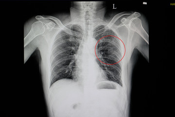 chest x-ray of a blunt chest wall injuried patient