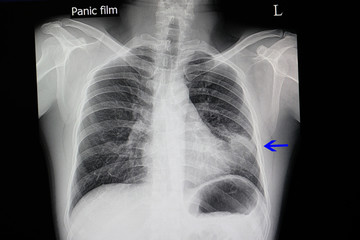 chest x-ray of a patient with pneumonia