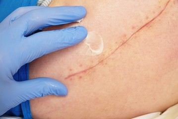The hand of the nurse performs the hip massage. Patient with a long scar