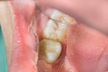 caries spoiled tooth closeup photographed