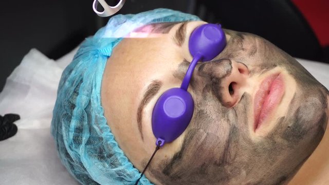 Beautician laser removes old skin with carbon fiber layer. Processing of forehead area. Carbon peeling.