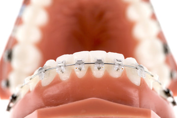 Orthodontic braces on a white background