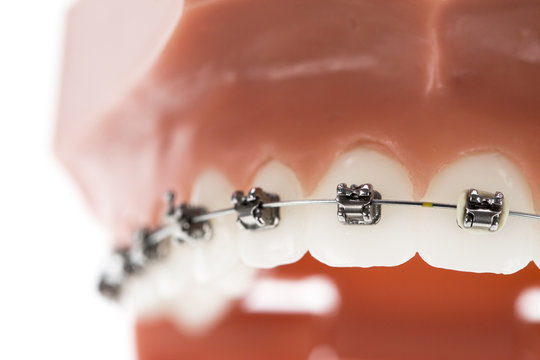 Orthodontic braces on a white background