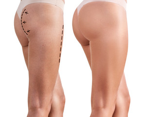 Woman's buttocks before and after plastic surgery - 194543503