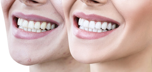 Teeth of young woman before and after whitening.