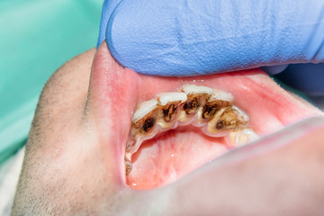 close-up of a human rotten carious tooth at the treatment stage in a dental clinic