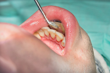 close-up of a human rotten carious tooth at the treatment stage in a dental clinic