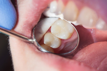 close-up of a human rotten carious tooth at the treatment stage in a dental clinic