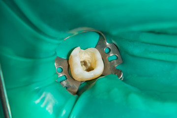 closeup treated human tooth in a dental filling rotten clinic