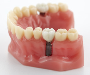 Close up of a Dental implant model.
