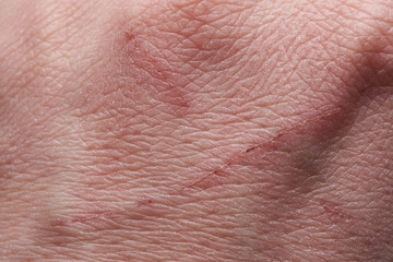 Fototapeta premium Damaged with scratch human skin