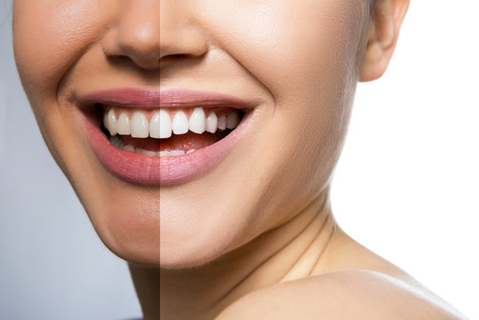 Female teeth and skin befor and after care, therapy and whitening. Laughing woman mouth with great teeth over white background. Healthy beautiful female smile.