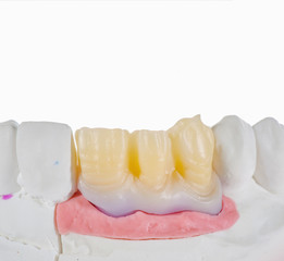 Technical shots of tooth prosthesis on a dental prothetic laboratory