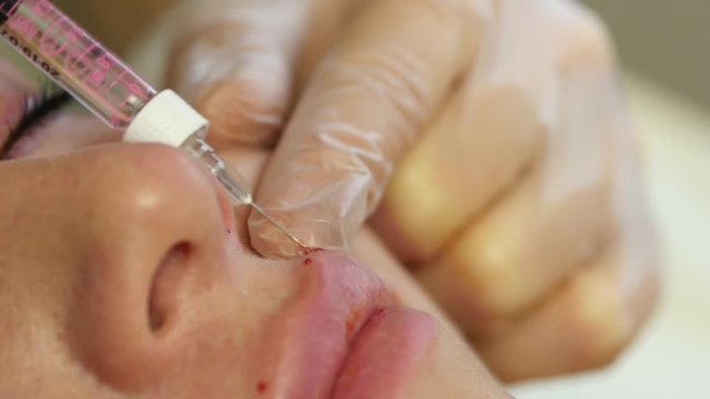 cosmetologist make injection into the womans lips. lip augmentation and plastic surgery. 4K